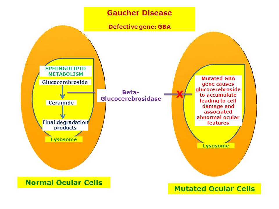 Gaucher Disease Hereditary Ocular Diseases